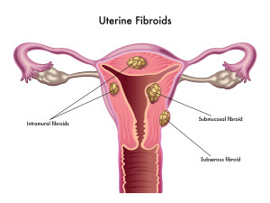 uterine fibroids leiomyoma myomatous uterus