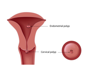 Uterine Polyps Polyps Fertility Toronto Infertility Naturopath